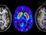 کشف نخستین نشانه‌های بیماری پارکینسون در مغز