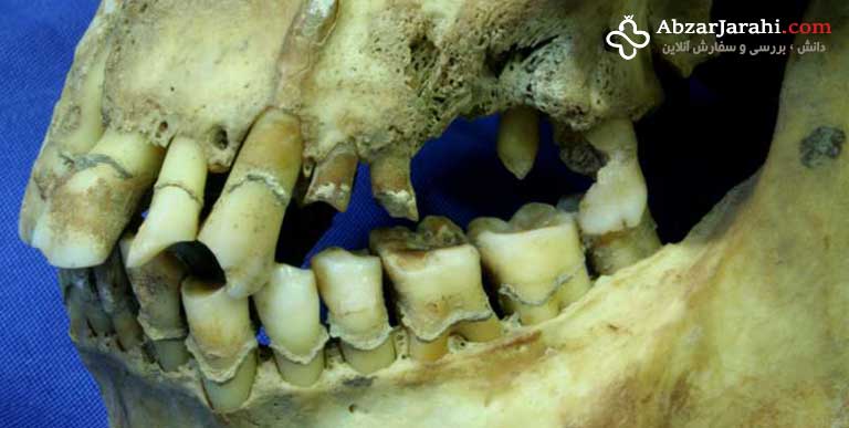 انسان‌های اولیه هم دچار مشکلات دندان مشابه ما می‌گشتند