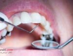ژل ترمیم‌کننده جدید می‌تواند جایگزین عمل پرکردن دندان گردد