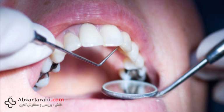 ژل ترمیم‌کننده جدید می‌تواند جایگزین عمل پرکردن دندان گردد